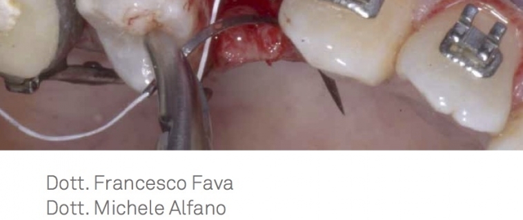 Ortodonzia nel paziente implantare: linee guida e strategie per il successo