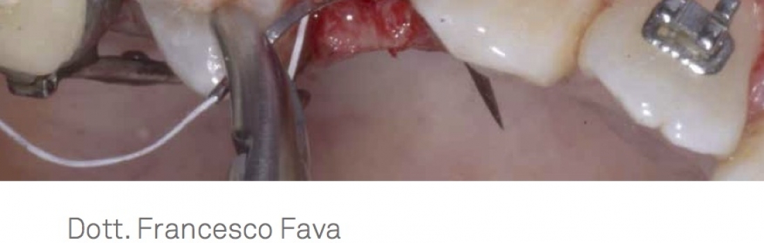 Ortodonzia nel paziente implantare: linee guida e strategie per il successo