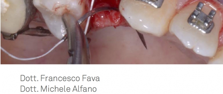 Ortodonzia nel paziente implantare: linee guida e strategie per il successo