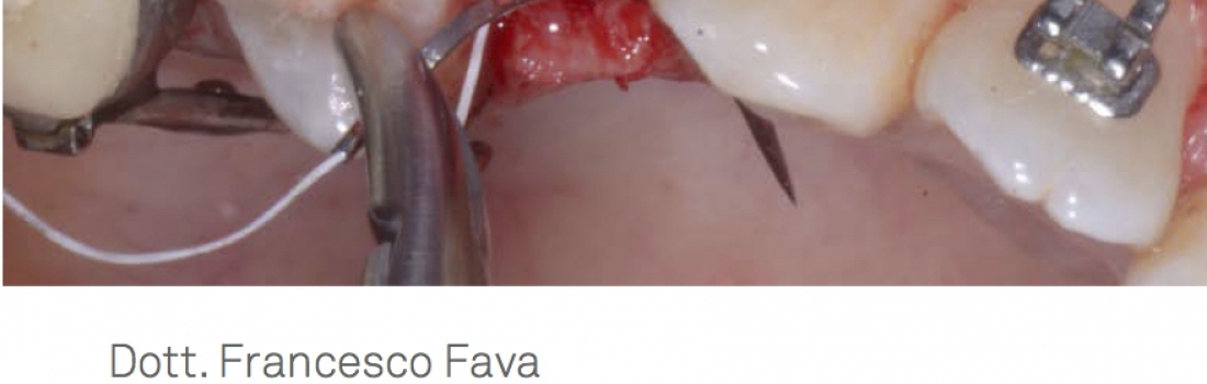 Ortodonzia nel paziente implantare: linee guida e strategie per il successo